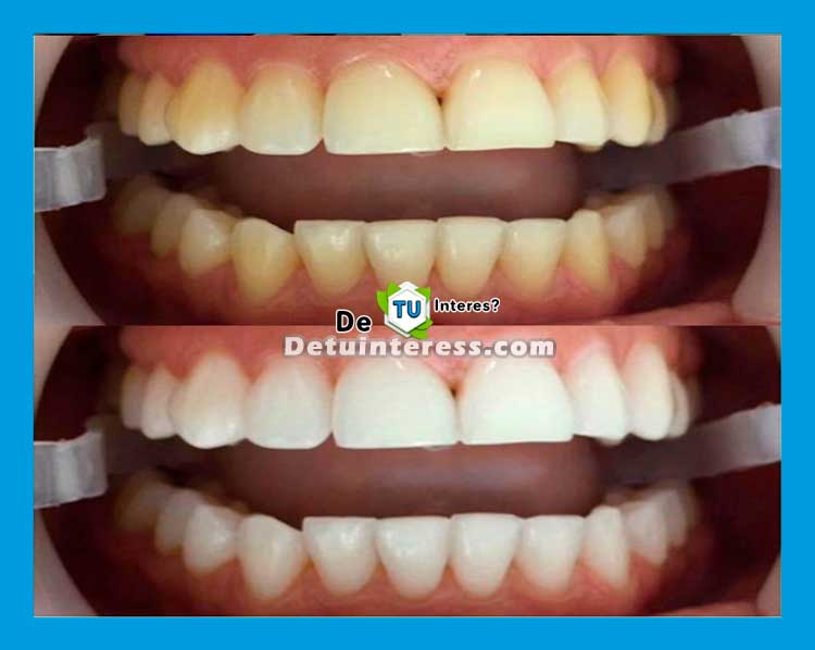 Productos comerciales para blanquear los dientes Productos comerciales para blanquear los dientes